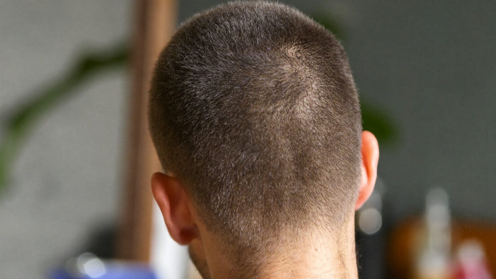 Back of a man's head with dense, healthy short hair in the donor area
