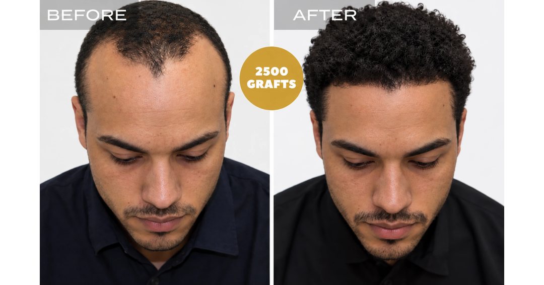 Before and after photos of a curly-haired patient: hairline and density rebuilt using 2,500 FUE grafts at Nova Medical Tennessee
