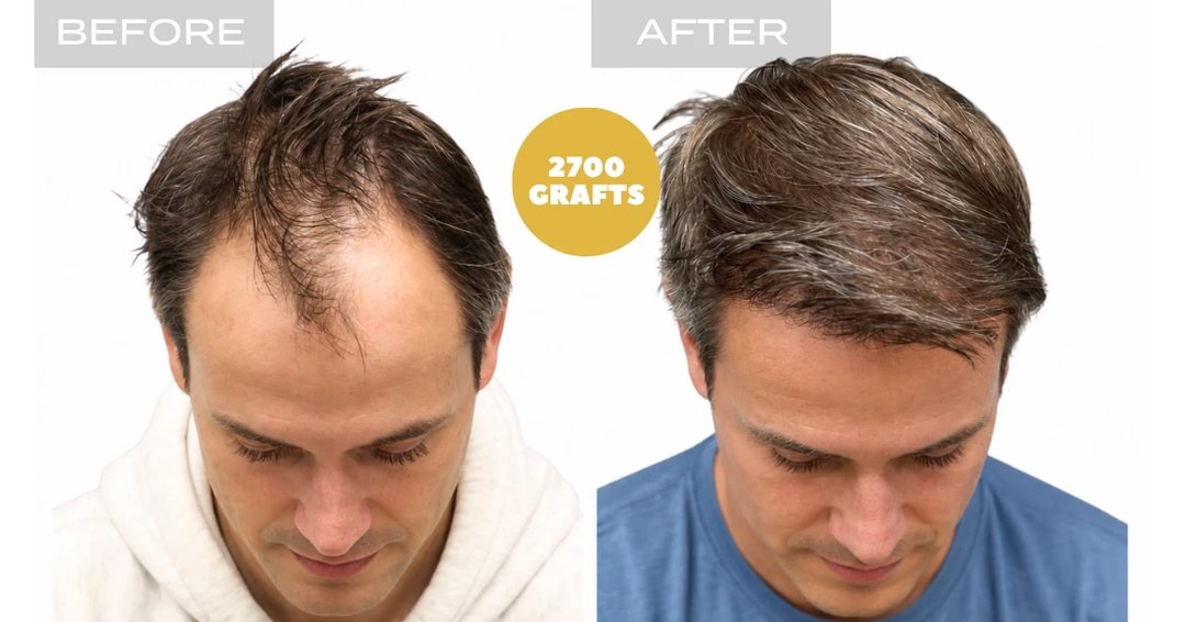 Receding hairline before and after: frontal density restored with 2,700 FUE grafts at Nova Medical Tennessee