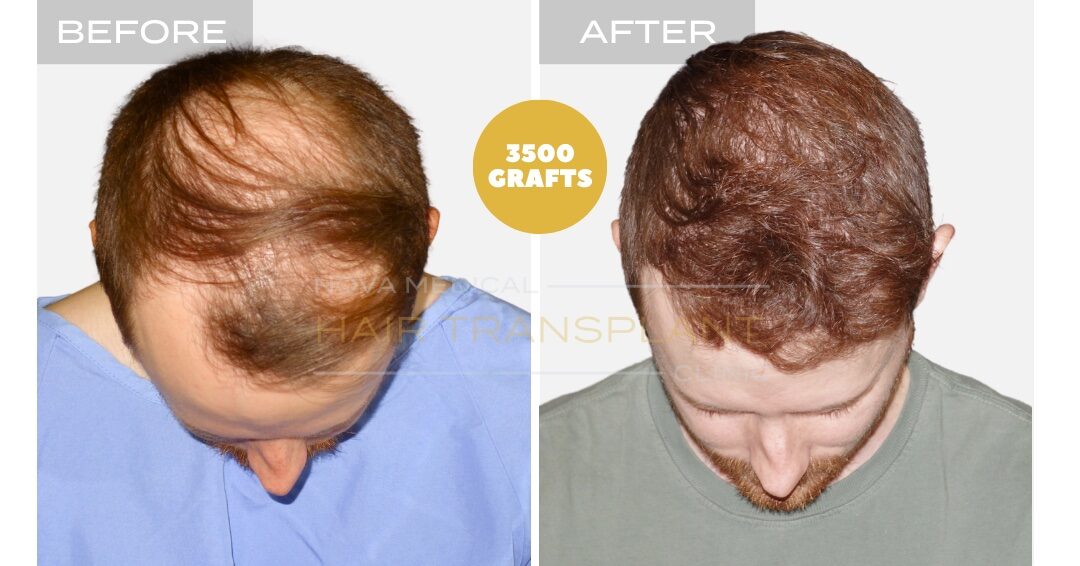Nova Medical Tennessee before and after, case 2: New hairline plus a fuller crown (3,500 grafts, micro FUE)