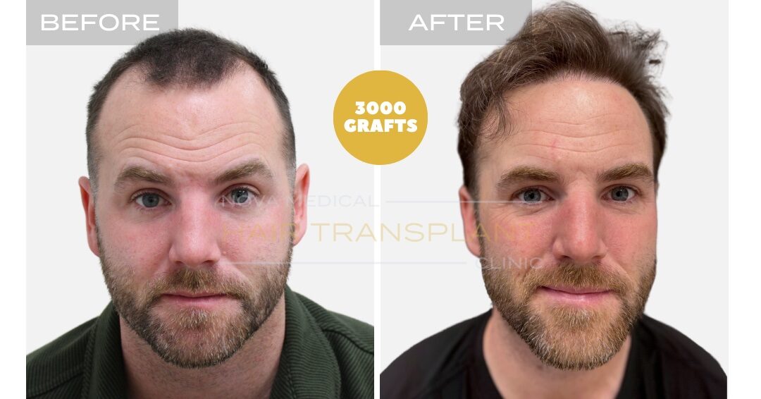 Nova Medical Tennessee before and after, case 4: Hairline restored, gaps filled (3,000 grafts, manual FUE)