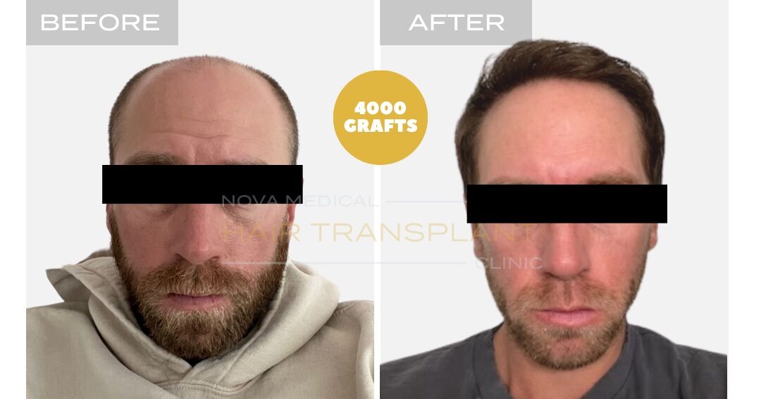 Nova Medical Tennessee before and after, case 5: New hairline plus a fuller crown (4,000 grafts, manual FUE with DHI)