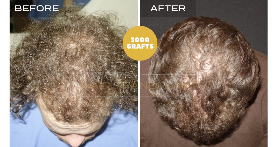 Nova Medical Tennessee before and after, case 6: Curly hair, thickness added (3,000 grafts, no-shave manual FUE)