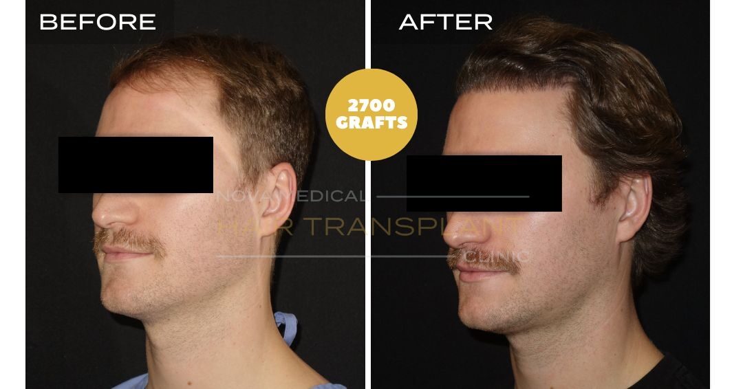 Nova Medical Tennessee before and after, case 7: Hairline and thickness rebuilt (2,700 grafts, manual FUE)