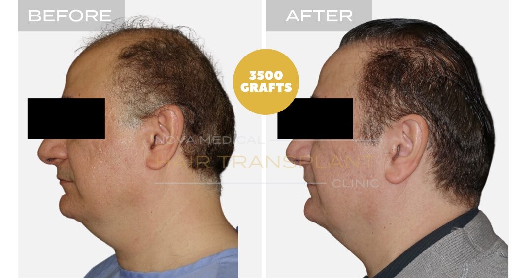 Nova Medical Tennessee before and after, case 8: New hairline plus a fuller crown (3,500 grafts, manual FUE)