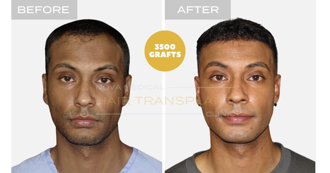 Nova Medical Tennessee before and after, case 9: Hairline in coarse, thick hair (3,500 grafts, manual FUE)