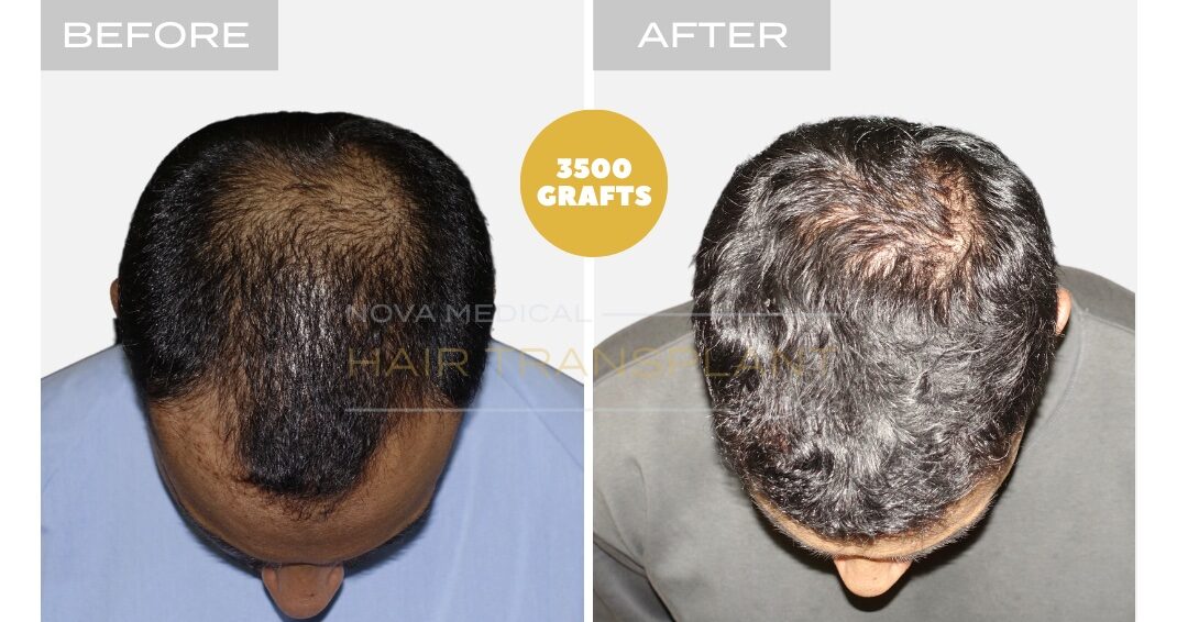 Nova Medical Tennessee before and after, case 10: Hairline in coarse, thick hair (3,500 grafts, manual FUE)