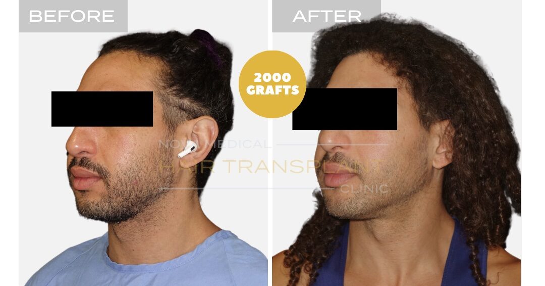 Nova Medical Tennessee before and after, case 12: Curly hairline without a full shave (2,000 grafts, manual FUE)