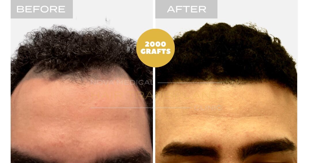 Nova Medical Tennessee before and after, case 13: Hairline restored, gaps filled (3,000 grafts, manual FUE)