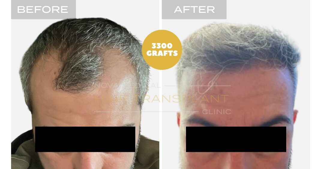 Nova Medical Tennessee before and after, case 14: Hairline with a fuller front (3,000 grafts, manual FUE)