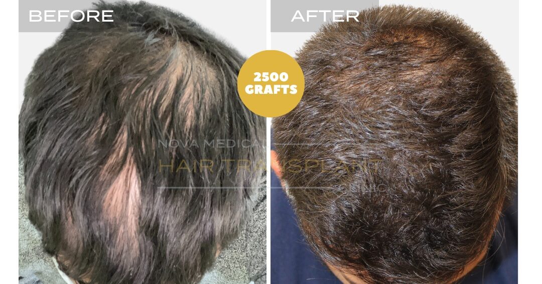 Nova Medical Tennessee before and after, case 15: Hairline plus crown thickness (3,000 grafts, manual FUE)