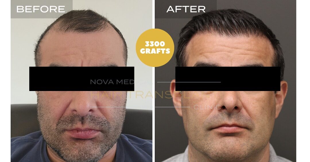 Nova Medical Tennessee before and after, case 16: Hairline with a fuller front (3,300 grafts, manual FUE with DHI)
