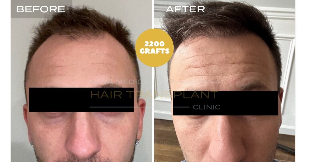 Nova Medical Tennessee before and after, case 17: Hairline and crown filled in (2,200 grafts, manual FUE)