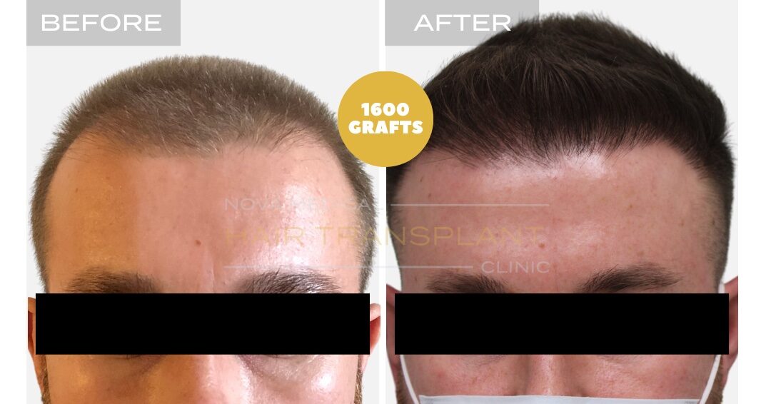 Nova Medical Tennessee before and after, case 18: Hairline touch-up session (1,600 grafts, manual FUE)