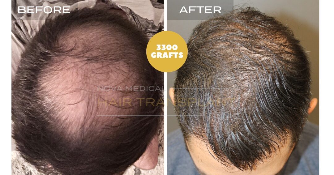 Nova Medical Tennessee before and after, case 19: Crown and hairline rebuilt together (3,300 grafts, manual FUE)