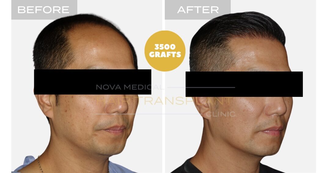 Nova Medical Tennessee before and after, case 20: Closely packed hairline (asian hair, 3,500 grafts, manual FUE)