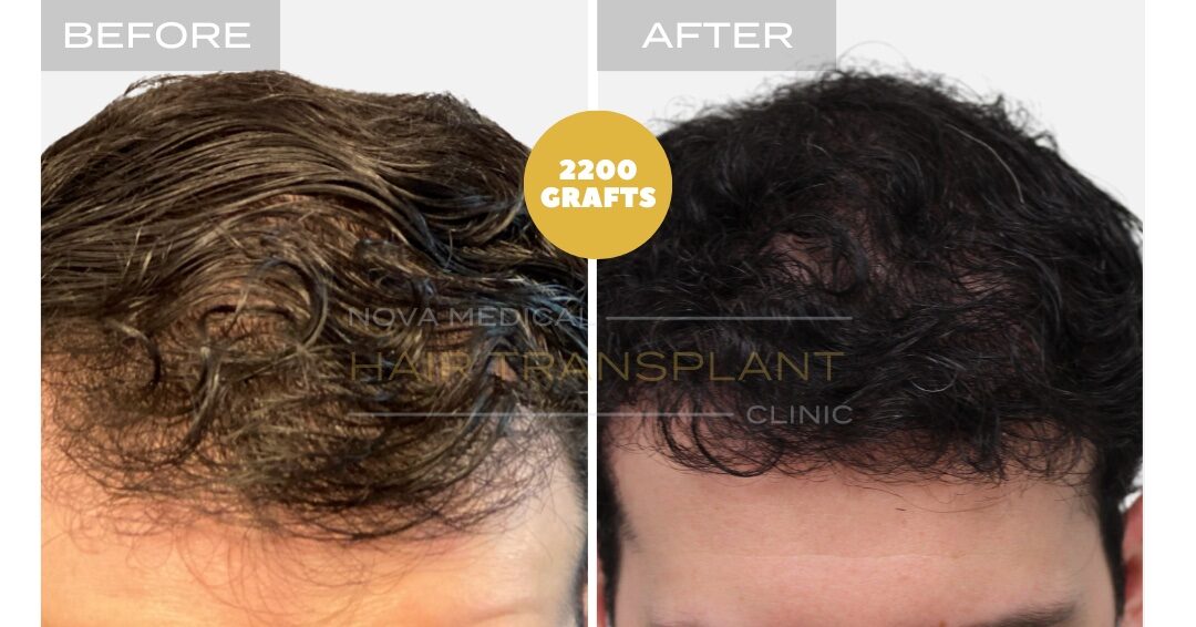 Nova Medical Tennessee before and after, case 21: Hairline and thickness rebuilt (2,200 grafts, manual FUE)