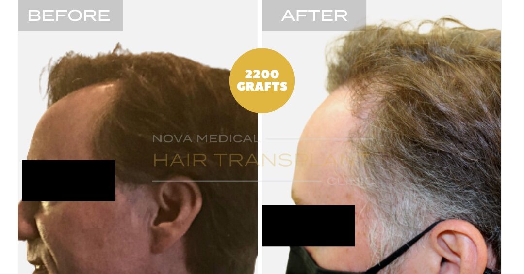 Nova Medical Tennessee before and after, case 22: Temples filled, hairline restored (2,200 grafts, manual FUE)