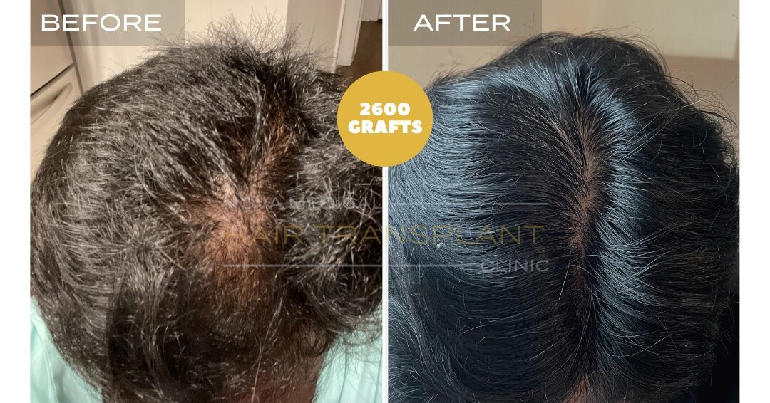 Nova Medical Tennessee before and after, case 23: Fuller crown (2,600 grafts, manual FUE)