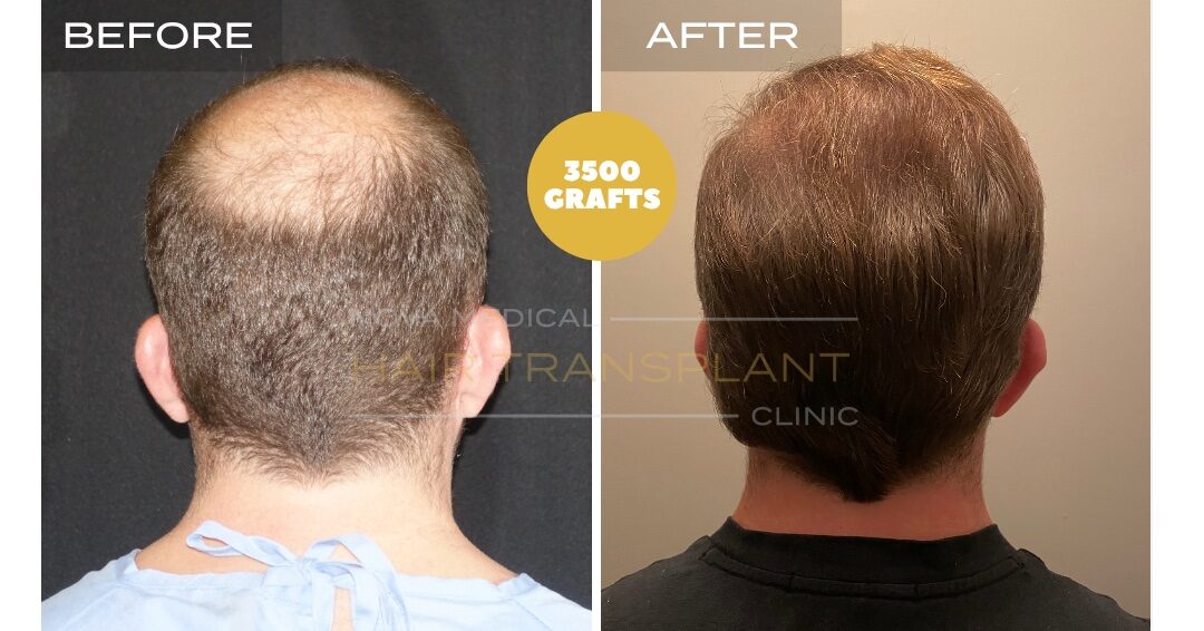 Nova Medical Tennessee before and after, case 24: Fuller crown (3,500 grafts, manual FUE)