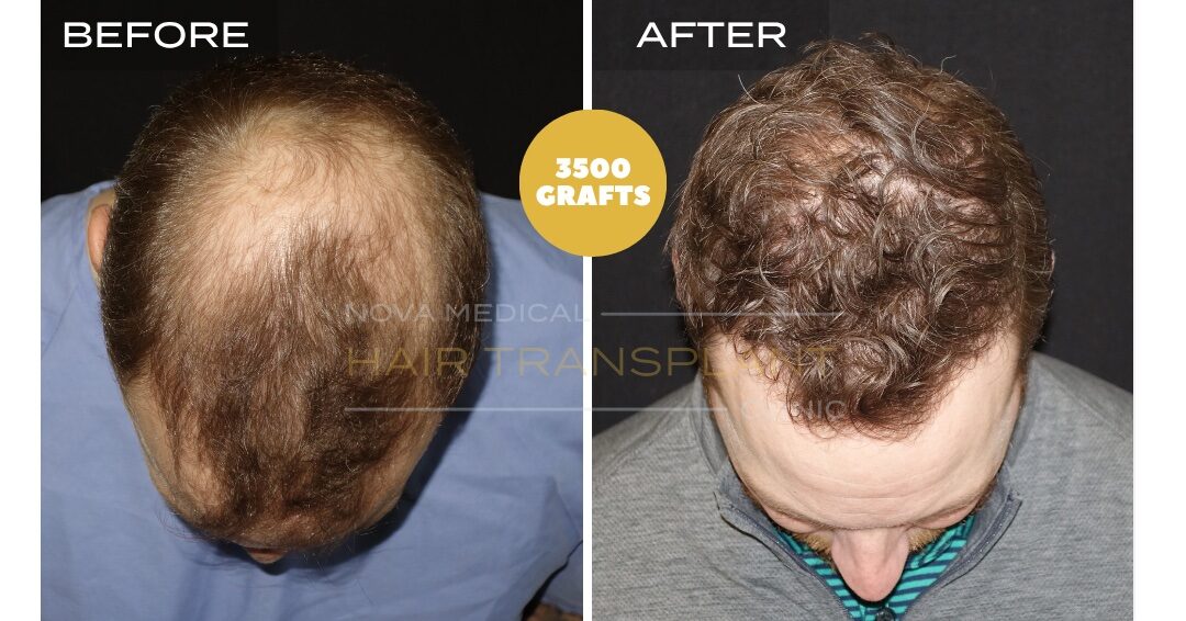 Nova Medical Tennessee before and after, case 25: Crown and hairline rebuilt together (3,500 grafts, manual FUE)