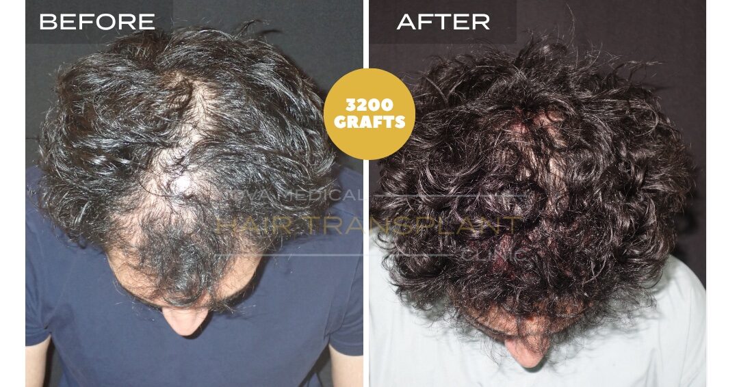 Nova Medical Tennessee before and after, case 26: Overall thickness restored (3,200 grafts, micro FUE)