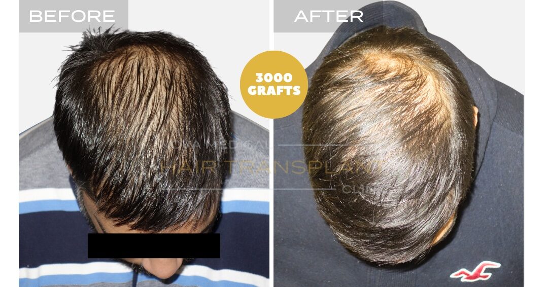 Nova Medical Tennessee before and after, case 27: Hairline and thickness rebuilt (3,000 grafts, manual FUE)