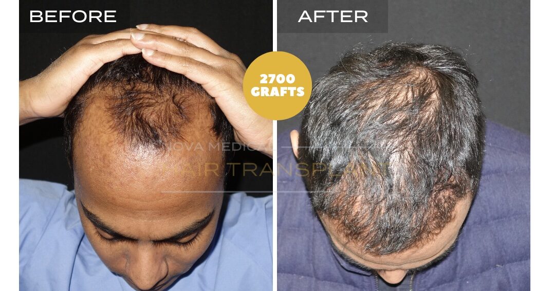 Nova Medical Tennessee before and after, case 28: Hairline and thickness rebuilt (2,700 grafts, manual FUE)