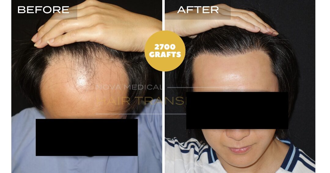 Nova Medical Tennessee before and after, case 29: Hairline brought forward (2,700 grafts, manual FUE)