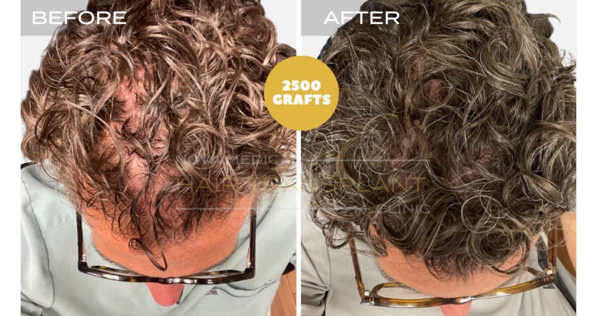 Nova Medical Tennessee video case 1: Curly hair without a full shave (2,500 grafts, manual FUE, thickness added)