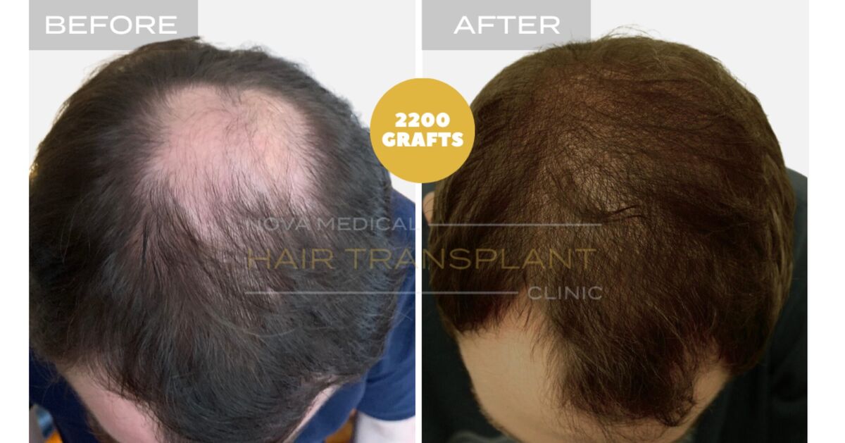 Nova Medical Tennessee video case 2: Thin crown filled in (2,200 grafts, manual FUE with DHI)