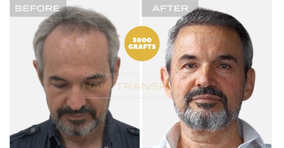 Nova Medical Tennessee video case 4: Hairline restored, gaps filled (3,000 grafts, manual FUE)