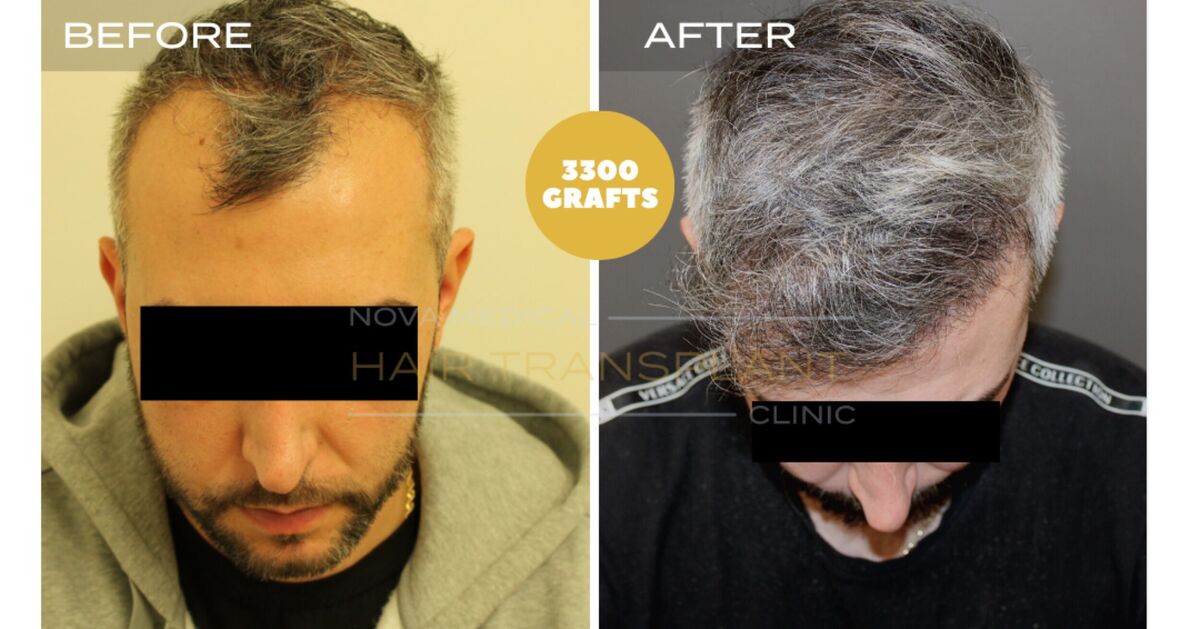 Nova Medical Tennessee video case 5: Hairline restored with added thickness (3,300 grafts, manual FUE)