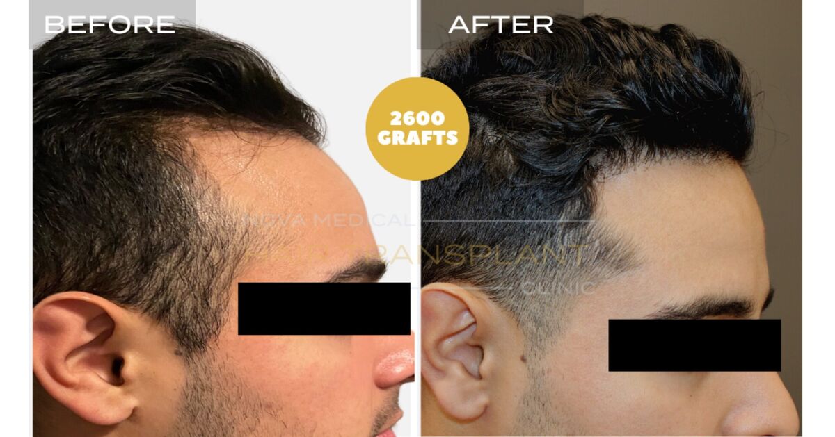 Nova Medical Tennessee video case 6: Temples filled, hairline restored (2,600 grafts, manual FUE)