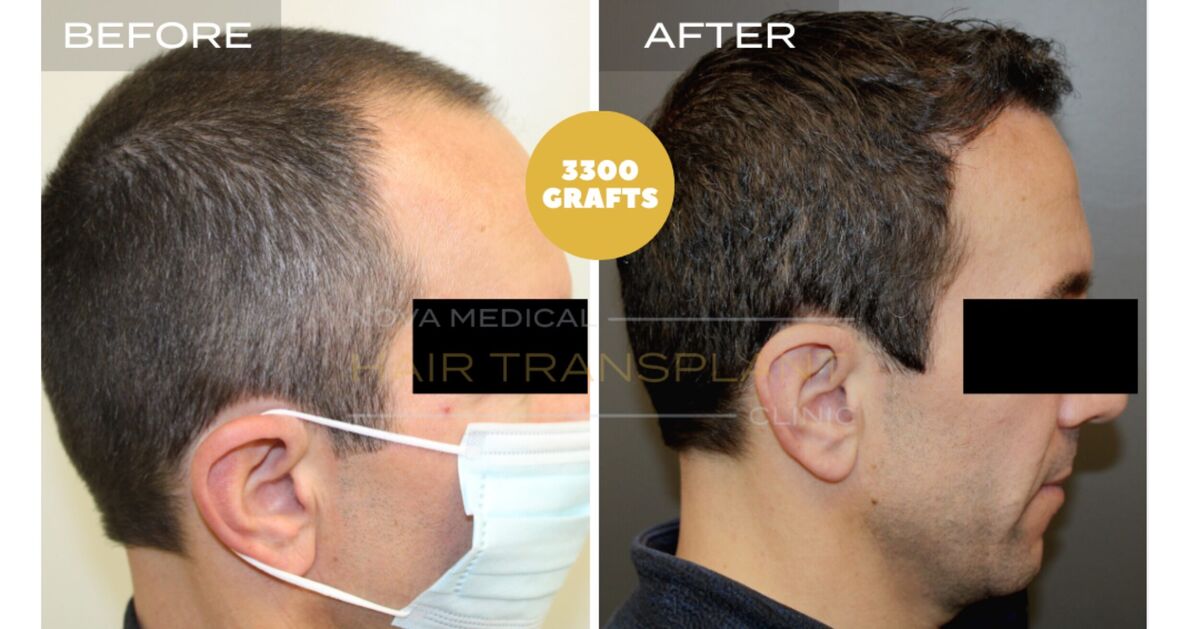 Nova Medical Tennessee video case 7: Temples filled, hairline restored (3,300 grafts, manual FUE)