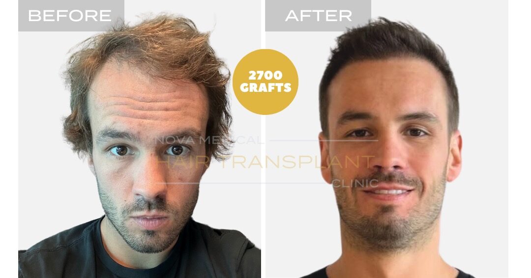 Hair Transplant Before and After - Patient 1, Nova Medical