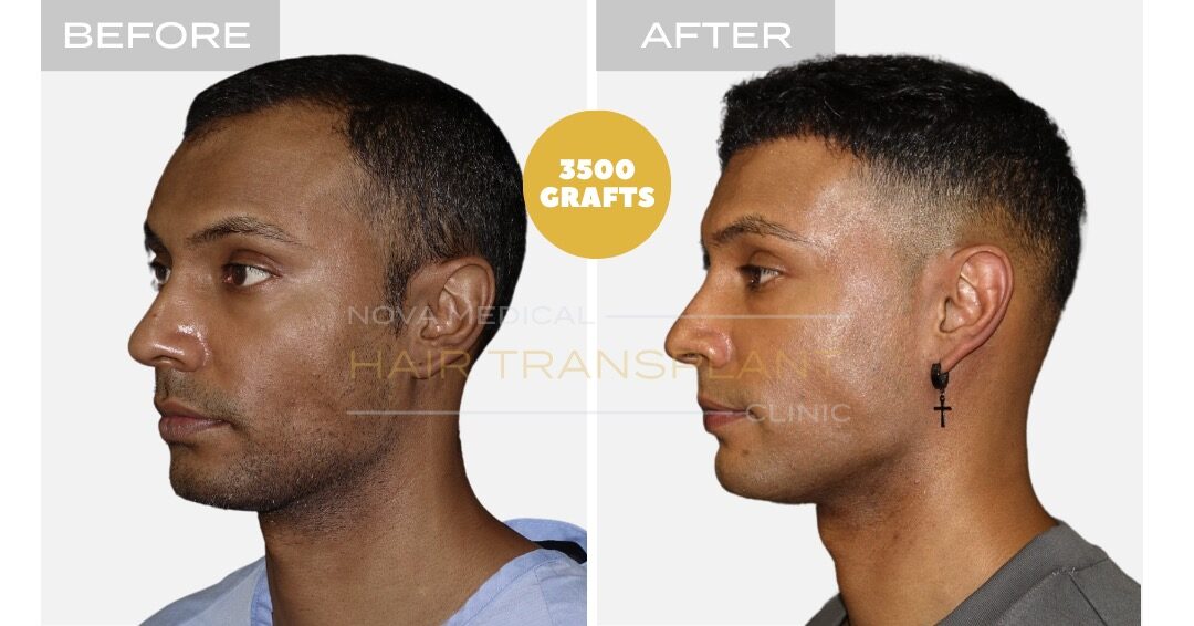 Hair Transplant Before and After - Patient 3, Nova Medical