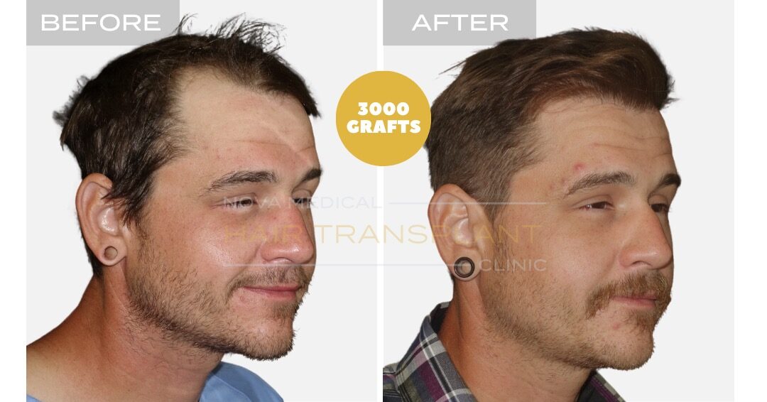 Hair Transplant Before and After - Patient 4, Nova Medical