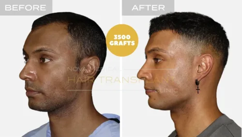 Hair transplant before and after result 3