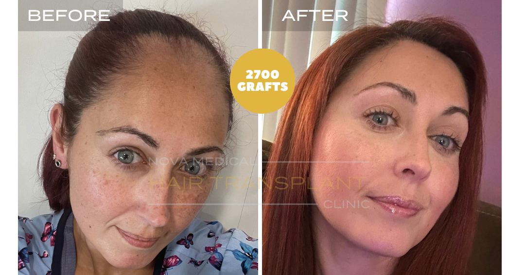 Hair transplant transformation result